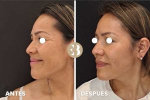 bótox antes y después patas de gallo