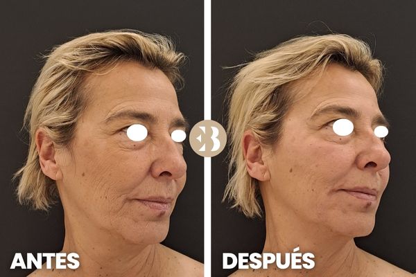 Aumento de Pómulos con Acido Hialurónico Antes y después en la Clinica de Medicina Estética EB en Madrid