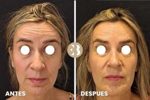 bótox antes y después en frente. eliminar arrugas en frente