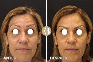 bótox antes y después en frente. eliminar arrugas en frente