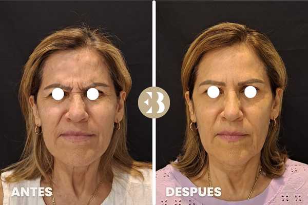 bótox antes y después entrecejo