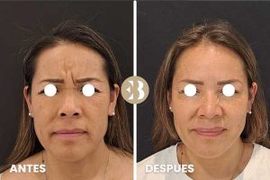 bótox antes y después entrecejo