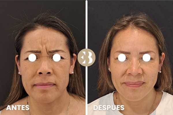bótox antes y después entrecejo