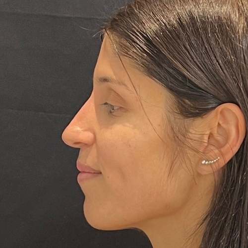 después de la rinomodelación en Clinica Medicina Estetica Eb en Madrid