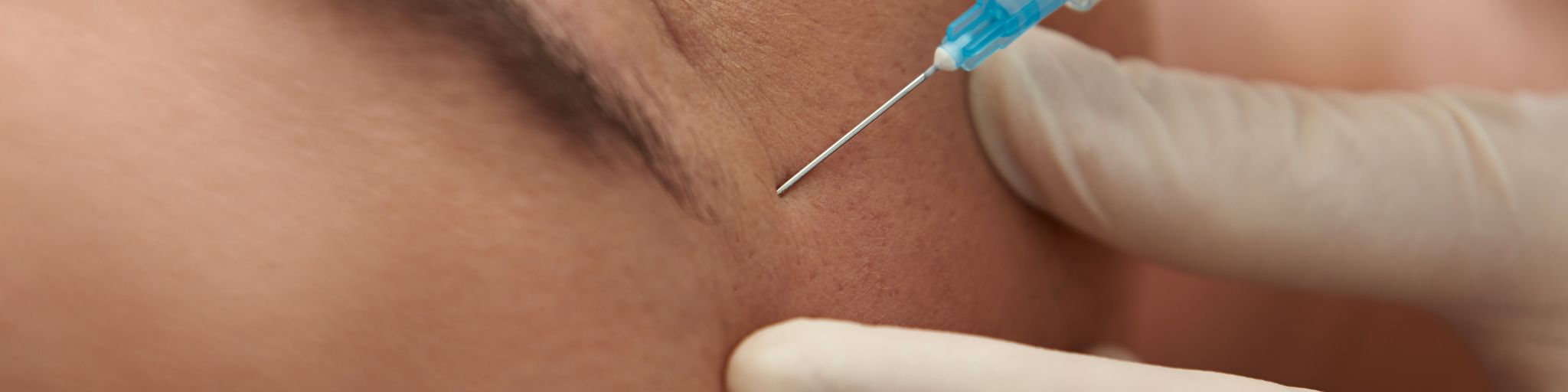 eliminar patas de gallo con acido hialuronico