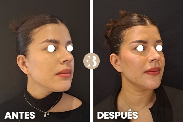 marcación mandibular antes y después