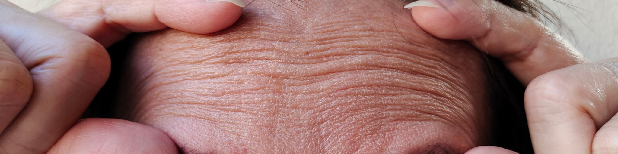 eliminar arrugas cara. Tratamientos para rejuvenecer el rostro en la Clinica de Medicina Estética EB en Madrid