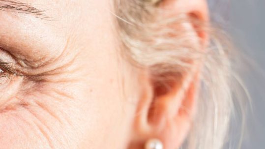 eliminar patas de gallo con medicina estetica y sin cirugia. Clinica EB