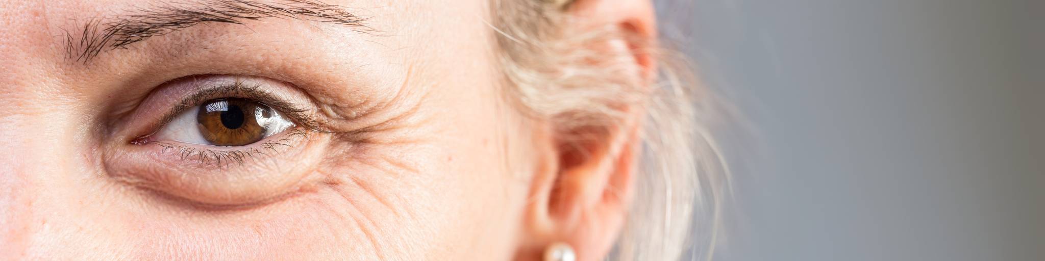 eliminar patas de gallo con medicina estetica y sin cirugia. Clinica EB