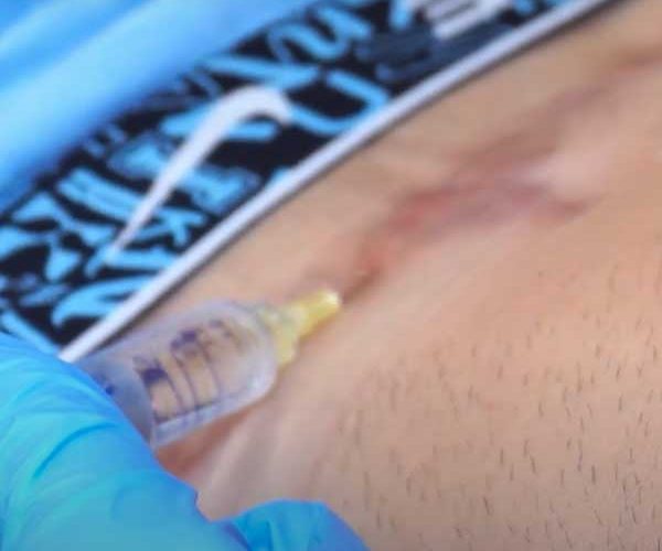 enzimas elimina cicatrices y estrias enzimas elimina cicatrices y estrias