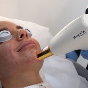 láser ipl facial