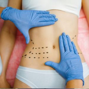 quitar grasa localizada abdomen con coolsculpting elite