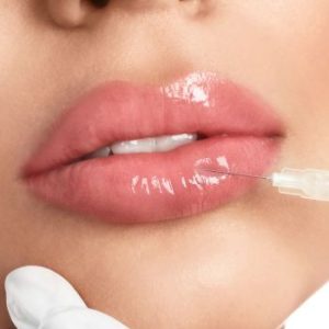 Ácido hialurónico labios en la clinica de medicina estetica eb