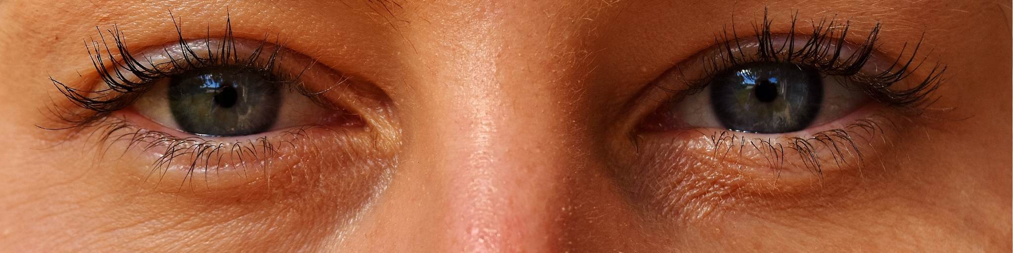 ácido hialurónico para ojeras