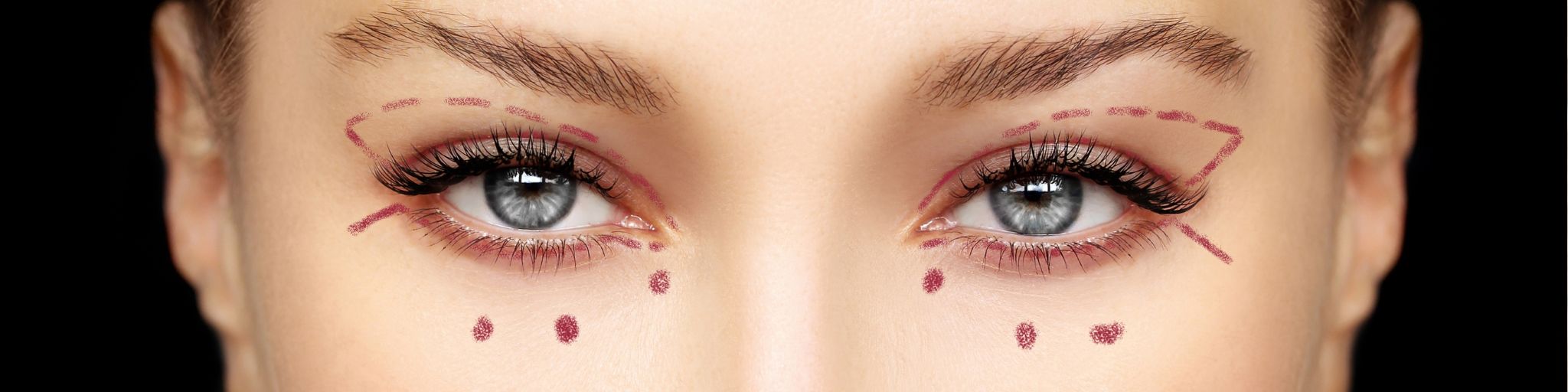 blefaroplastia o cirugia de párpado