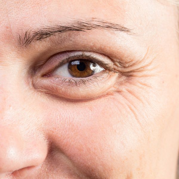 blefaroplastia precio superior