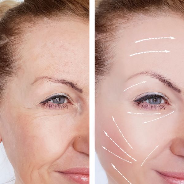 quitar arrugas con acido hialuronico